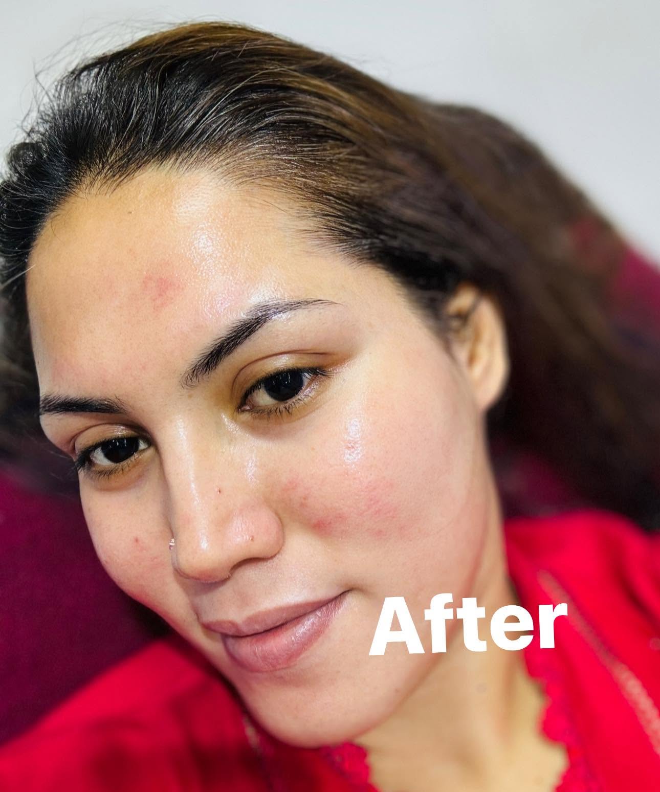 Skin transformation after