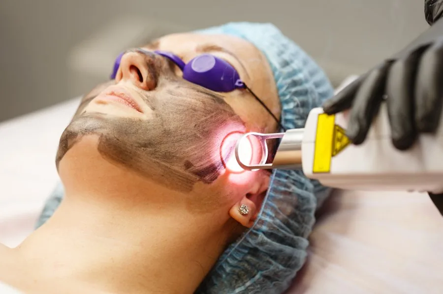 Carbon Laser treatment